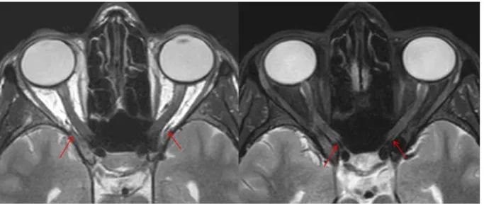 Figure 12: Séquences morphologiques : IRM en coupe axiale dans le plan des nerfs optiques, pondérée  en T2 sans (à gauche) puis avec (à droite) saturation du signal de la graisse permettant de repérer le  trajet des artères ophtalmiques (flèches)