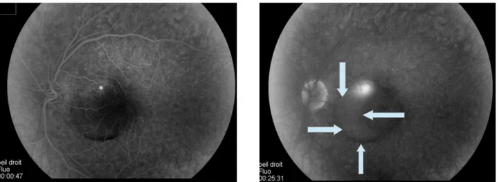 figure 12 : angiographie à la fluorescéine. Point de fuite angiographique apparaissant aux temps précoces et remplissant progressivement le DSR aux temps tardifs ( flèches )