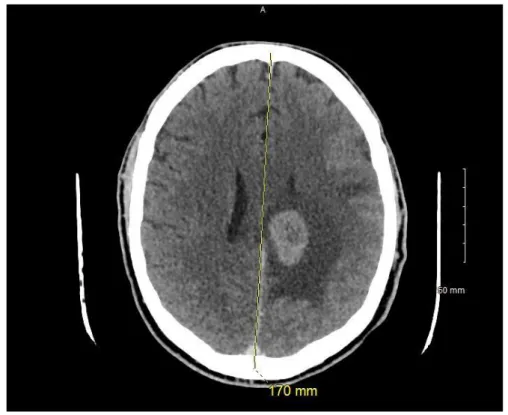 Figure 13 : Scanner cérébrale injecté, masse hyperdense, avec œdème péri lésionnel, au niveau de l’hémisphère gauche 