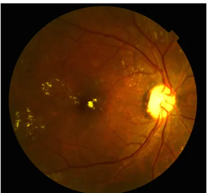 Figure 5. Rétinophotographie de l’œil droit d’un patient diabétique 