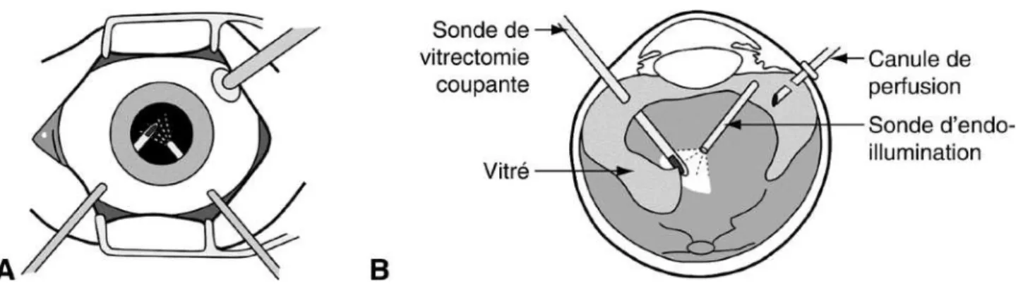 Figure  7  :  Représentation  schématique  de  la  réalisation  d’une  vitrectomie  par  la  pars  plana