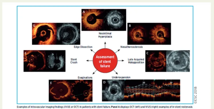 Figure 7 Intracoronary imaging for the assessment of stent failure.