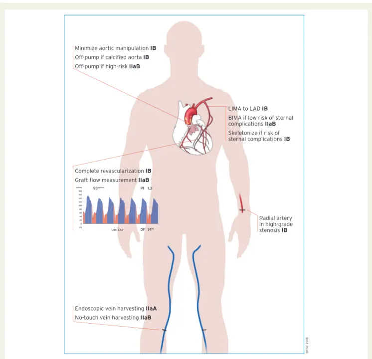 Figure 8 Technical aspects of CABG. BIMA = bilateral internal mammary artery; CABG = coronary artery bypass grafting; IMA = internal mam- mam-mary artery; LAD = left anterior descending coronary artery.