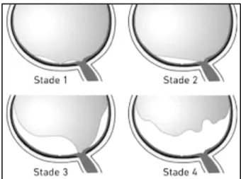 Figure  2:  Physiologie  décollement  postérieur  du  vitré.  Stade  1:  DPV  autour  de  la  fovéa,  persistance d’une adhérence fovéolaire