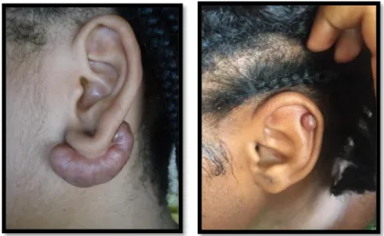 Figure 5 et 6 : Cicatrices chéloïdes du lobe et du pavillon de l'oreille 