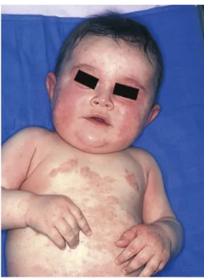 Figure 7 : Dermatite atopique du nourrisson. 