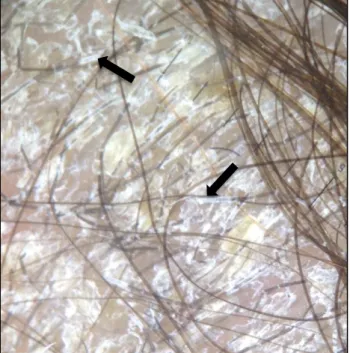 Figure  8 :  aspect  trichoscopique  des  gaines  blanchâtres  enduisant  les  cheveux  (flèches  noires) 