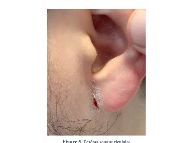 Figure 5 . Eczéma sous auriculaire 