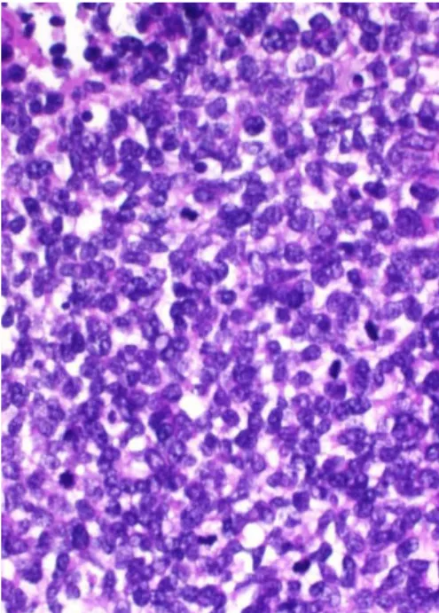 Figure 3 : Aspect microscopique d’un carcinome bronchique à petites cellules  (8) . 