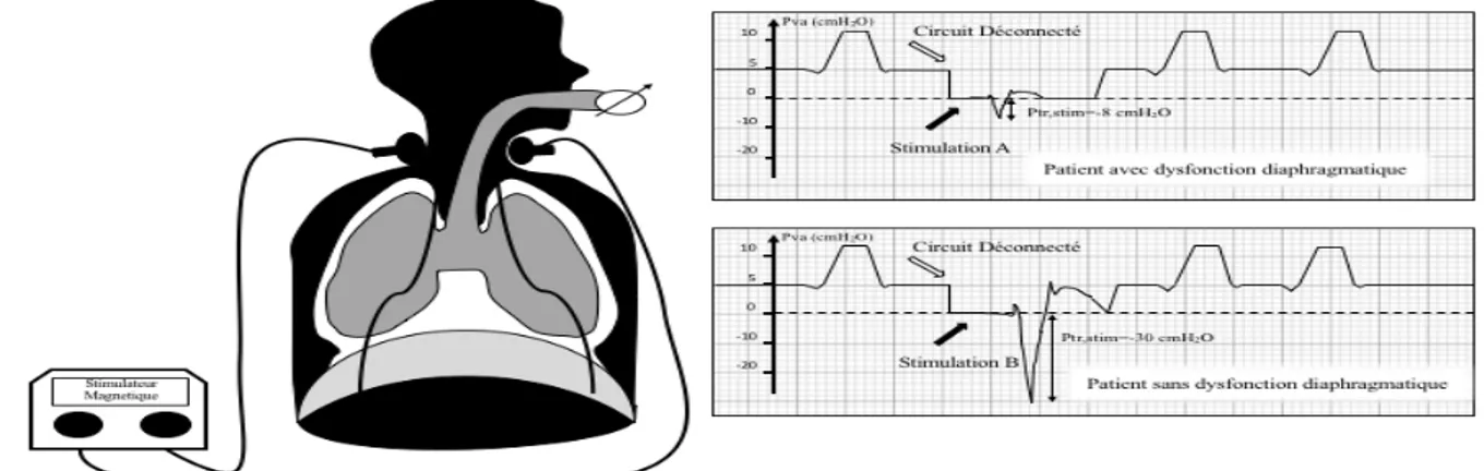 Figure  2 :  courbes  de  mesure  de  la  pression  trachéale.  Sur  la  courbe  A,  un  patient  présentant  une  dysfonction  diaphragmatique ;  sur  la  courbe  B,  un  patient  avec  une  fonction diaphragmatique normale