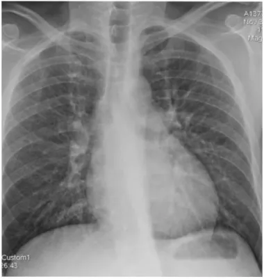 Figure 3 : Radiographie pulmonaire de face, syndrome interstitiel bilatéral à prédominance périhilaire 