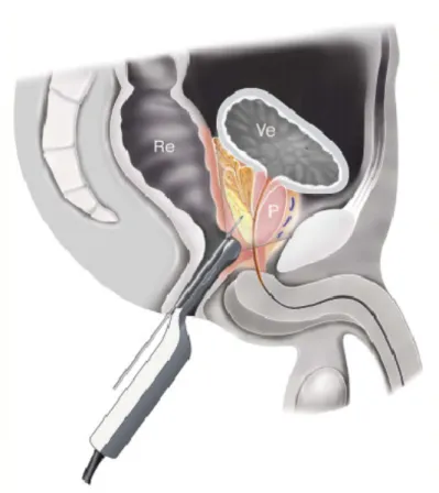 Figure 2 : Positionnement de la sonde d’échographie  [ 10 ] Re : rectum  - P : prostate - Ve : vessie 