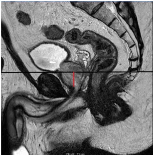 Figure 5 : Profondeur apicale (PA) 
