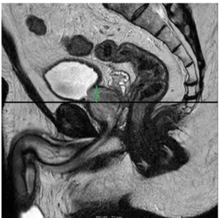 Figure 6 : Hauteur prostatique (HP) 