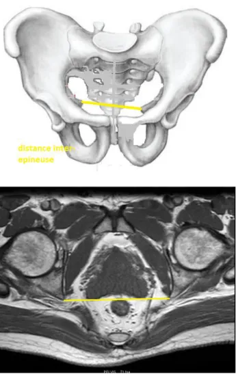 Figure 7 : Distance inter épineuse (DIP) 