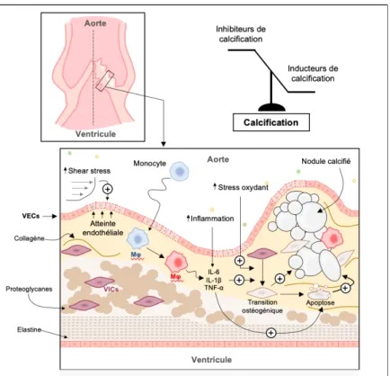 Figure 5 : Mécanismes physiopathologiques impliqués dans le développement du rétrécissement aortique  VECs : Cellules Endothéliales Valvulaires ; VICs : Cellules Interstitielles Valvulaires ; Mφ : macrophage ; IL :  Interleukine ; TNF : Tumor Necrosis Fact
