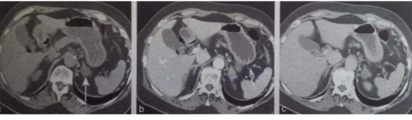 Figure  4 :  TDM  sans  et  avec  injection  intraveineuse :  adénome  cortical  pauvre  en  lipide (densité spontanée à 17 UH)