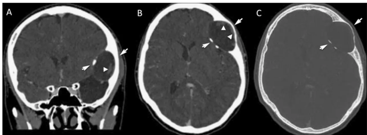 Fig. 2 MRI of a mass of the left parietal bone (arrow), displacing the contiguous brain parenchyma