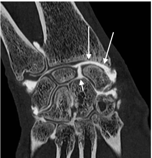 Figure 5 : coupe coronale d'arthroscanner passant par la ligne bi-styloïdienne mettant  en  évidence  une  chondropathie  de  type  SLAC  3,  avec  atteinte  des  régions   radio-scaphoïdiennes styloïdienne et proximale (flèches longues) et médiocarpienne 