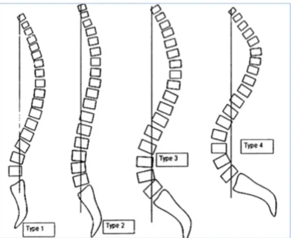 Figure 4 Classification de Roussouly 