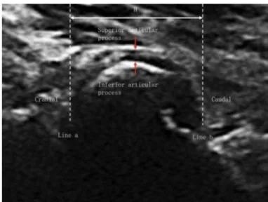 Figure   5   -  Schéma   de   l'articulation   facettaire   dans   le   plan   sagittal