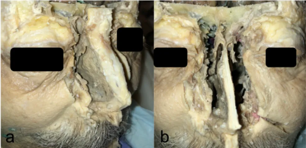 Figure 6 : Dissection sur tête fixée par  la méthode de Thiel modifiée. 