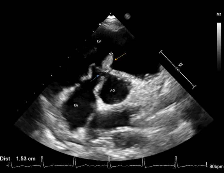 Figure 3 : Echocardiographie transoesophagienne de notre patiente. 