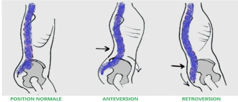 Figure 7: Antéversion et rétroversion du bassin VS posture normale. 