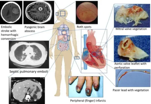 Figure 3 : Principales complications de l’EI 8 