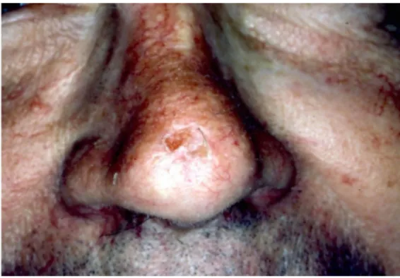 Figure   10   :   Carcinome   épidermoïde   de   la   joue   (35)           