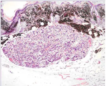 Figure 5: Coupe histologique d'un mélanome.