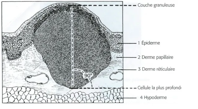 Figure 7 : Indice de Breslow. [3]