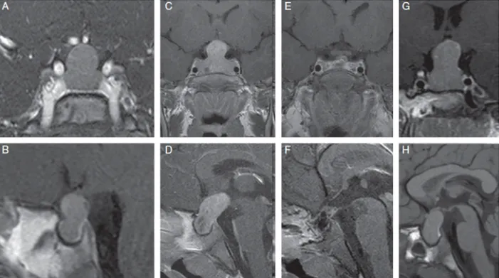 Fig. 2. Coronal and sagittal MRI images of patients with XLAG. Panels A and B. A large pituitary mass with important suprasellar extension in a female patient was revealed by gadolinium-enhanced MR imaging at diagnosis (2 years 11 months)