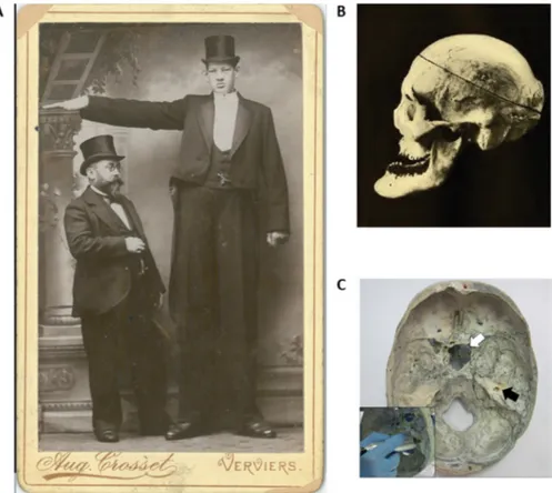 Fig. 6. A historical case of dramatic gigantism, the giant Constantin, who measured 259 cm