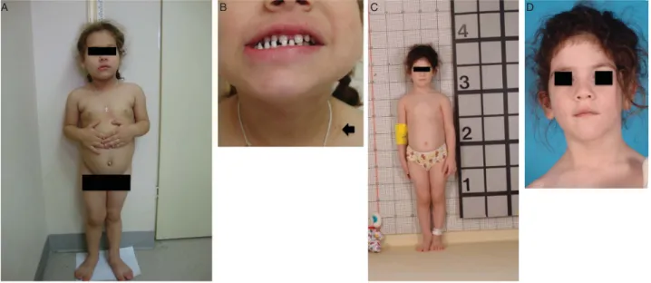 Table 2 Signs and symptoms reported in 18 patients with X-LAG syndrome at presentation