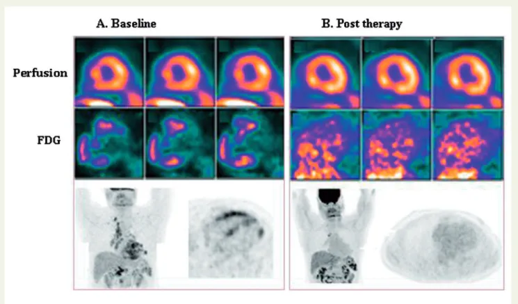 Figure 4 Example of FDG and myocardial perfusion PET in sarcoidosis: Assessing response to therapy with FDG PET