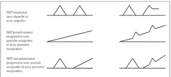 Figure 1: Formes évolutives de la sclérose en plaques