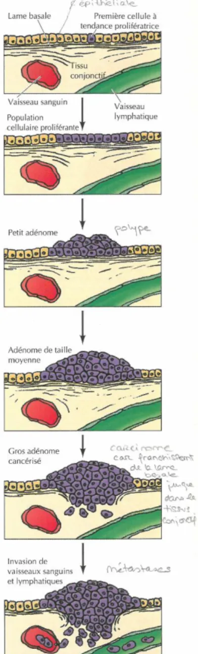 Figure 1 : développement  du carcinome du  colon, [4] 