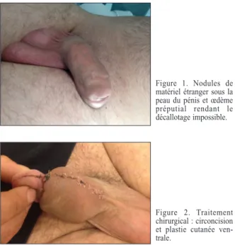 Figure 1. Nodules de  matériel étranger sous la  peau du pénis et œdème  préputial rendant le  décallotage impossible.