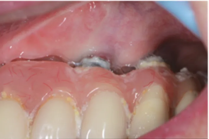 Figure 4 : Photo illustrant les conséquences d’une mauvaise hygiène bucco-dentaire                                 (photo du Dr Monnet Corti V.) 