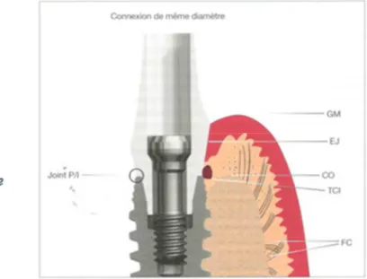 Figure 5 : Schéma matérialisant une connexion de même diamètre que celui de l’implant [65]