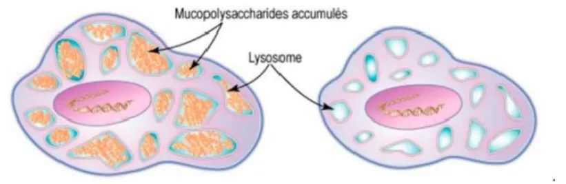 Figure 1 : Le lysosome et le lysosome malade dans la MPSII 