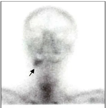 Figure : 1.10. Hyperfixation des maxillaires à droite (flèche). Noter l’insuffisance des repères 
