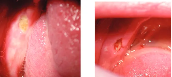 Fig. : 2.11. Ostéonécroses mandibulaires avérées gauche et droite chez une édentée complète