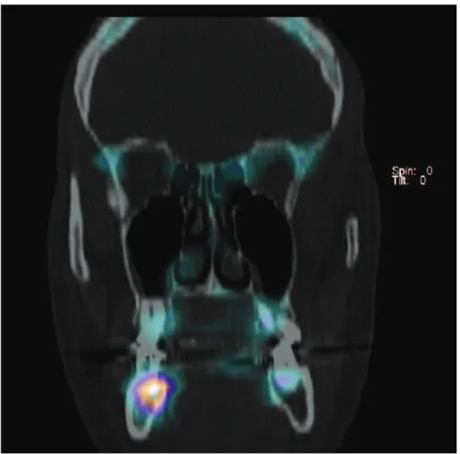 Fig. : 3.1. Couplage scintigraphie/tomodensitométrie coupe coronale : le repérage anatomique  de l’hyperfixation est facilité