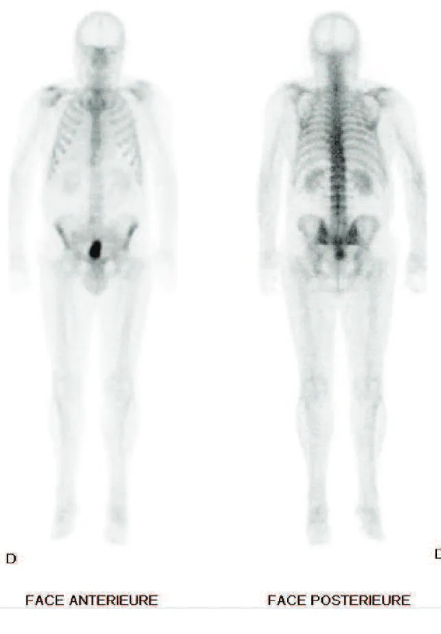 Fig. : 3.2. Scintigraphie (au 99mTc-BP) corps entier, vues faces antérieure et postérieure  (D r  S.QUERELLOU) 