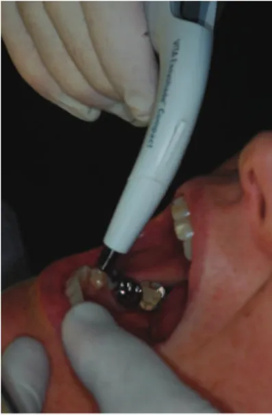 Fig. 3.3  :  prise  de  la  teinte  et  des  caractéristiques  anatomiques  de  la dent 