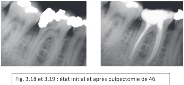 Fig. 3.18 et 3.19 : état initial et après pulpectomie de 46 