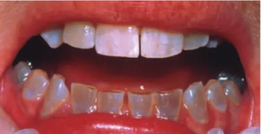 Fig  1.1. :  Aspect  clinique  dÕune  forme  moyenne  de  dentinognse  imparfaite  de  type  I  sur  denture  dfinitive, coloration brun violet (Cundy, 2012)