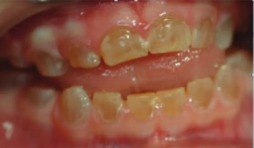 Fig 1.4. : Aspect clinique de la denture temporaire chez ce jeune patient : teinte caractristique jaune brun  (Dpartement dÕodontologie pdiatrique, universit de Brest, 2012)